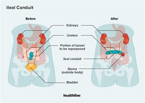 Ileal Conduit Purpose Procedure and Care