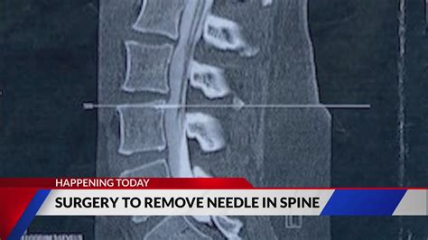 Illinois woman having surgery to remove needle in spine today