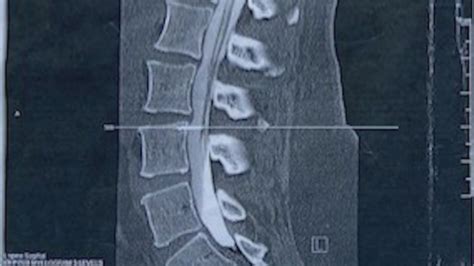 Illinois woman living with broken needle in her spine