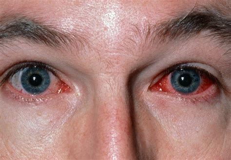 Image Viral Conjunctivitis MSD Manual Professional Edition