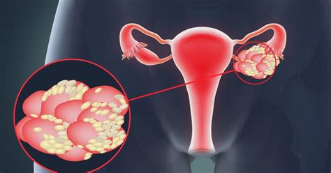 Imagerie du syndrome des ovaires polymicrokystiques (SOPMK)