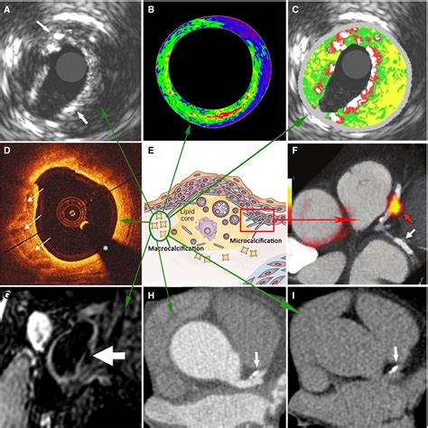 Imaging Cardiovascular Calcification Journal of the …