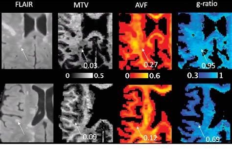 Imaging G-Ratio in Multiple Sclerosis Using High-Gradient …