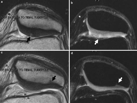 Imaging in Patellofemoral Pain SpringerLink