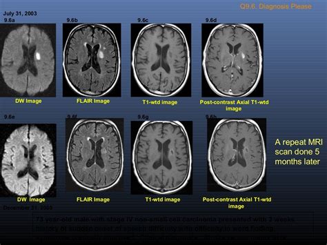 Imaging in stroke - SlideShare