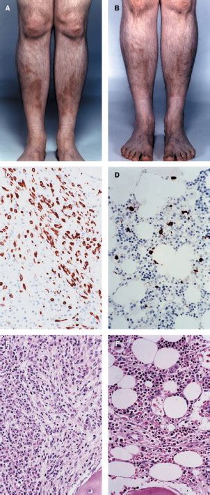 Imatinib for systemic mast-cell disease - The Lancet