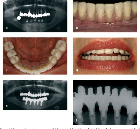 Immediate occlusal loading of Osseotite implants in the lower