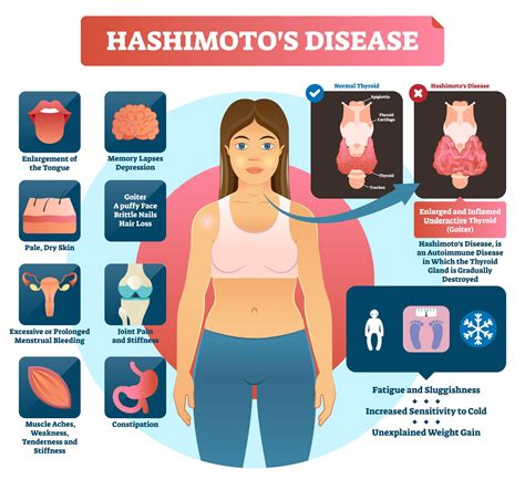 Immune disorders.  Hashimoto’s thyroiditis is the most common type of this health...
