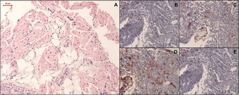 Immunosuppressive treatment in fulminant myocarditis and gene ...