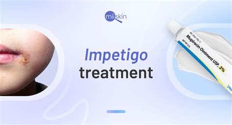 Impetigo behandling
