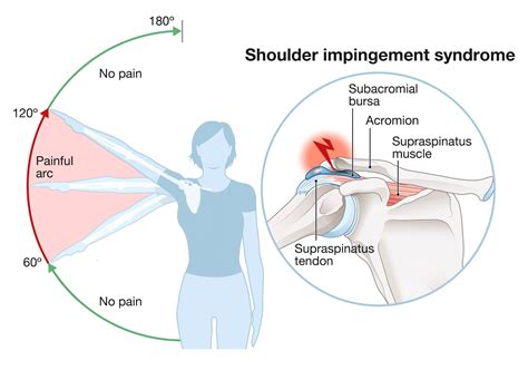 Impingement axel
