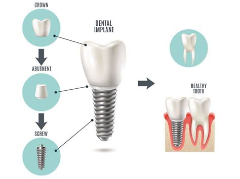 Implant Crown Cost In Mexico - Implant Crown Price - Dental …