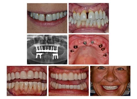 Implant Restorative Components - BRODINE PROSTHODONTICs