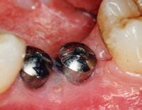 Implant Surgery and High-Frequency Currents - Dentistry Today