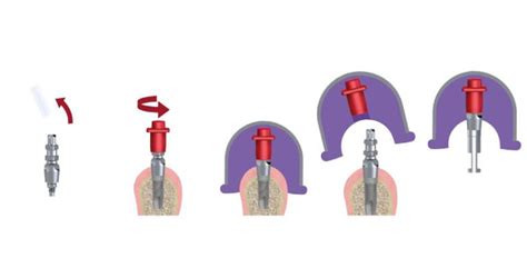 Implant analog and coping.  This technique recaptures the manageability of the pop...