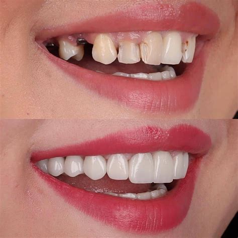 Implant diş kaç tl