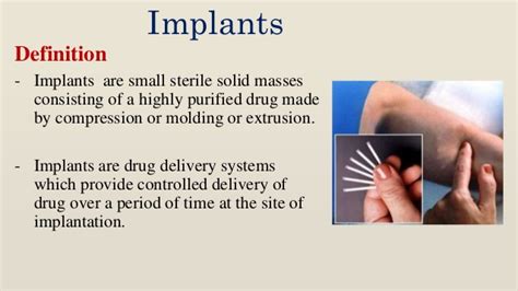 Implantable - definition of implantable by The Free …