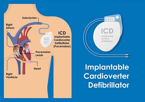 Implantable cardioverter defibrillator a practical manual reprint. - Nueva era de acuario y nuevo orden mundial.