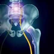 Improving the management of sciatica - The Lancet Rheumatology