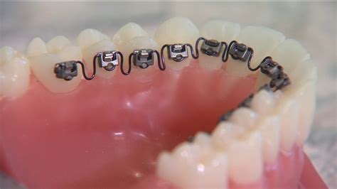 Inbrace. Summary: The InBrace system allows for tooth movement on autopilot because it is a fixed, compliance-free orthodontic system that has the capability of moving teeth to their programmed position in all six degrees of freedom, including opening or closing spaces. 