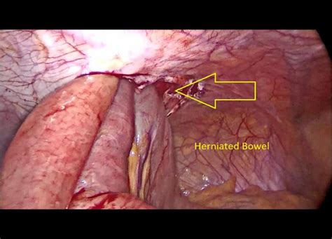 Incarcerated 5-mm Port Site Hernia: A Systematic Literature …