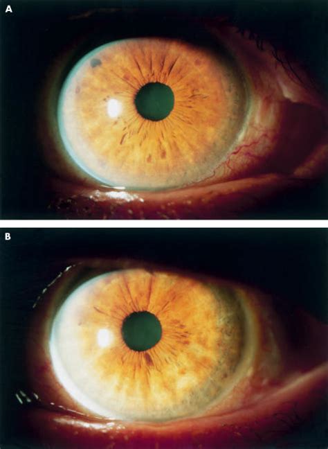 Incidence and severity of iris pigmentation on latanoprost-treated ...