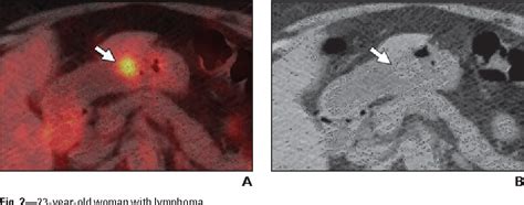 Incidental Finding of Focal FDG Uptake in the Bowel …