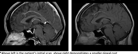 Incidental Pineal Cysts: Is Surveillance Necessary?