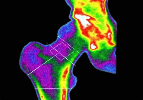 Increased Fracture Risk Associated with Epidural Steroid Injections