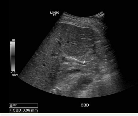 Increased echogenicity of liver causes. .  ...