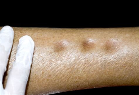 Indent skin. What is a cellular dermatofibroma? Cellular dermatofibromas are a type of dermatofibroma (noncancerous tumor). They appear as firm bumps (nodules), often on … 