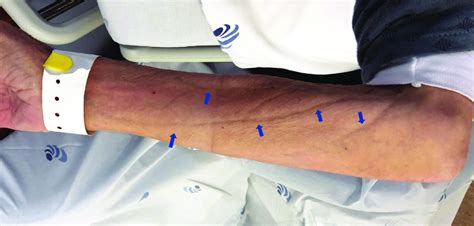 Indentation of the skin. Induration is characteristic of panniculitis, some skin infections, and cutaneous metastatic cancers. Umbilicated lesions have a central indentation and are ... 