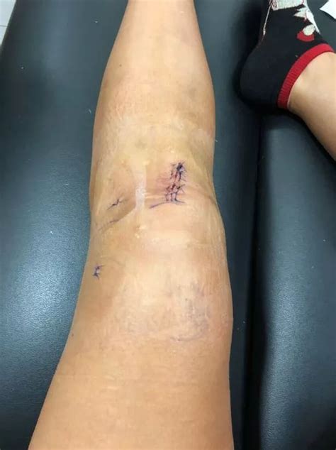 Infamous swoosh knee injury. The knee is an essential joint of the body, and it’s complex. It connects the thigh with the rest of the leg. It supports almost all of the human body’s weight, making the knee sus... 
