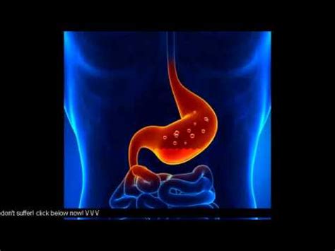 Infant Acid Reflux looks like this - YouTube