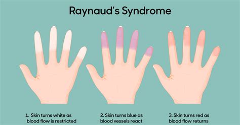 Infant with Blue Hands and Blue Feet....... Raynaud