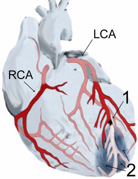 Infarkt – Wikipedia