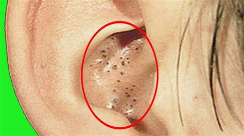 Infected blackhead in ear. Since your ears are so delicate and easily irritated, Dr. Shokeen recommends "using a gentle cleanser and a mild exfoliant" to help unclog pores. "Any product used in or around the ear should be ... 