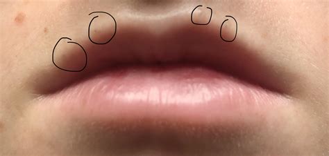 Infected blackhead on upper lip. Things To Know About Infected blackhead on upper lip. 