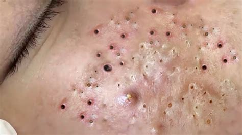 Infected blackheads youtube. 29M views 5 years ago. Blackheads. blackheads removal. Blackheads on cheeks, Pimple popping video https://amzn.to/2JWKYLP - BESTOPE Blackhead … 