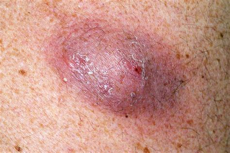 If a cyst has become infected, it may look red due to inflammation. Infected cysts can also have a whitish appearance due to the presence of pus. The pus may …. 