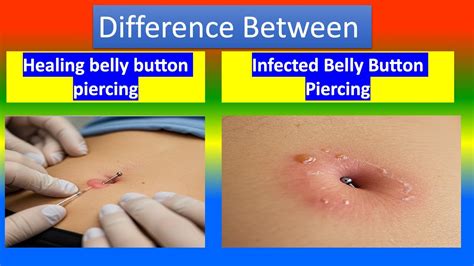 Infected piercing bump.  Bacteria can infect a belly button piercing before healing is comple...