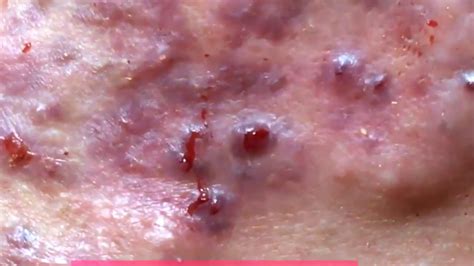 Jul 17, 2016 · 0:00 / 4:39. Huge Infected Pimple Popping on Face : Incision & Drainage of infected Cysts (INFLAMMATORY ACNE) Dr KK Karade ENT Head Neck Thyroid …. 