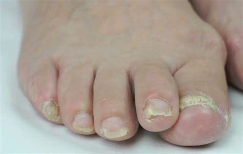 Fungal nail infections may cause nails t