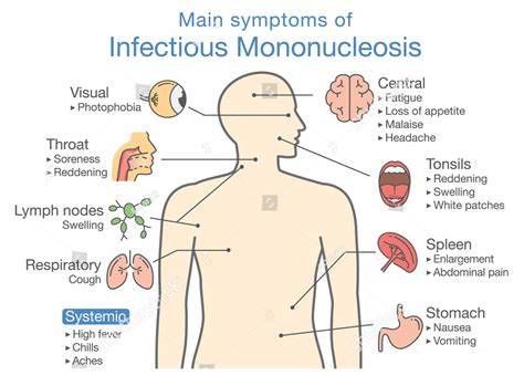 Infectious mononucleosis.  Learn how it's spread, diagnosed, treated, Learn about the cau...