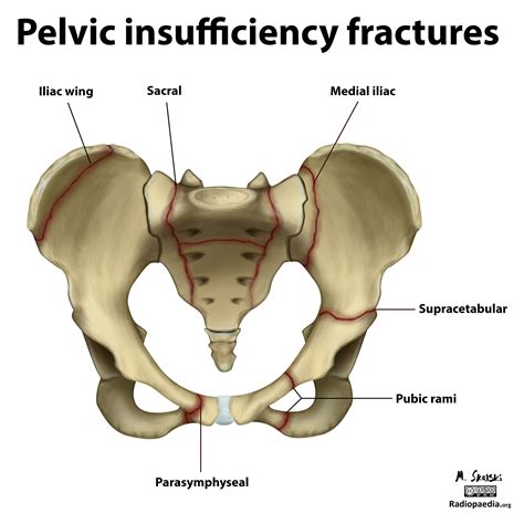 Introduction. Older patients presenting on the acute medical take with pelvic fragility fractures (PFF) represent an increasing epidemic. 1 The most common pelvic fracture identified by plain X-ray is that of the pubic rami. 2 PFF are painful and despite optimal analgesia, many of these patients struggle to mobilise. Between 60% and 80% of …. 