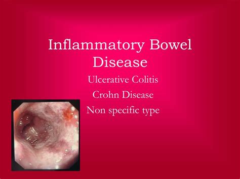 Inflammatory bowel disease - SlideServe