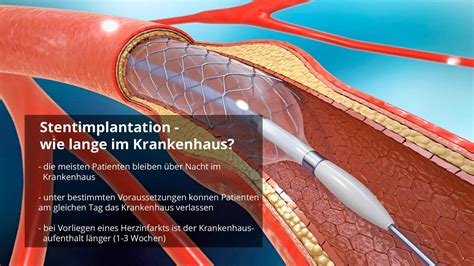 Information nach Stentimplantation - ers