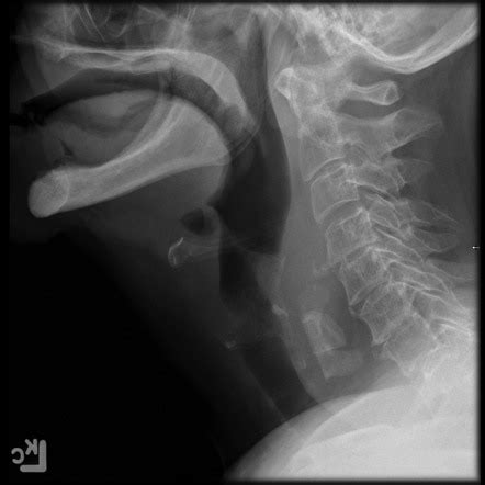 Ingested bones Radiology Reference Article