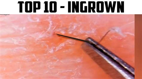 Ingrown hair cysts can show up on any part of the body that has hair, but they commonly develop on the parts that you shave, including: 1. Face 2. Armpits 3. Pubic area 4. Legs A cyst from an ingrown hair can be red, white, or yellow. An ingrown hair cyst looks like a pimple, but it can grow bigger. … See more. 