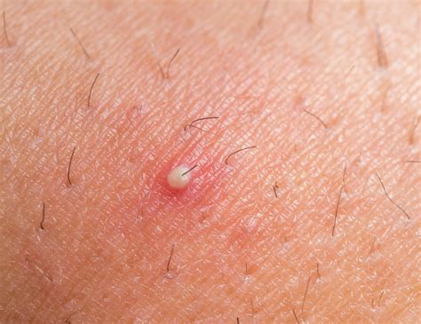 Ingrown hair icd10. Dear Lifehacker (After Hours),What's the best way to trim my, uh, private 